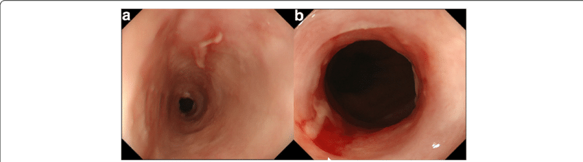 Endoscopic view of the esophagus 565 days post