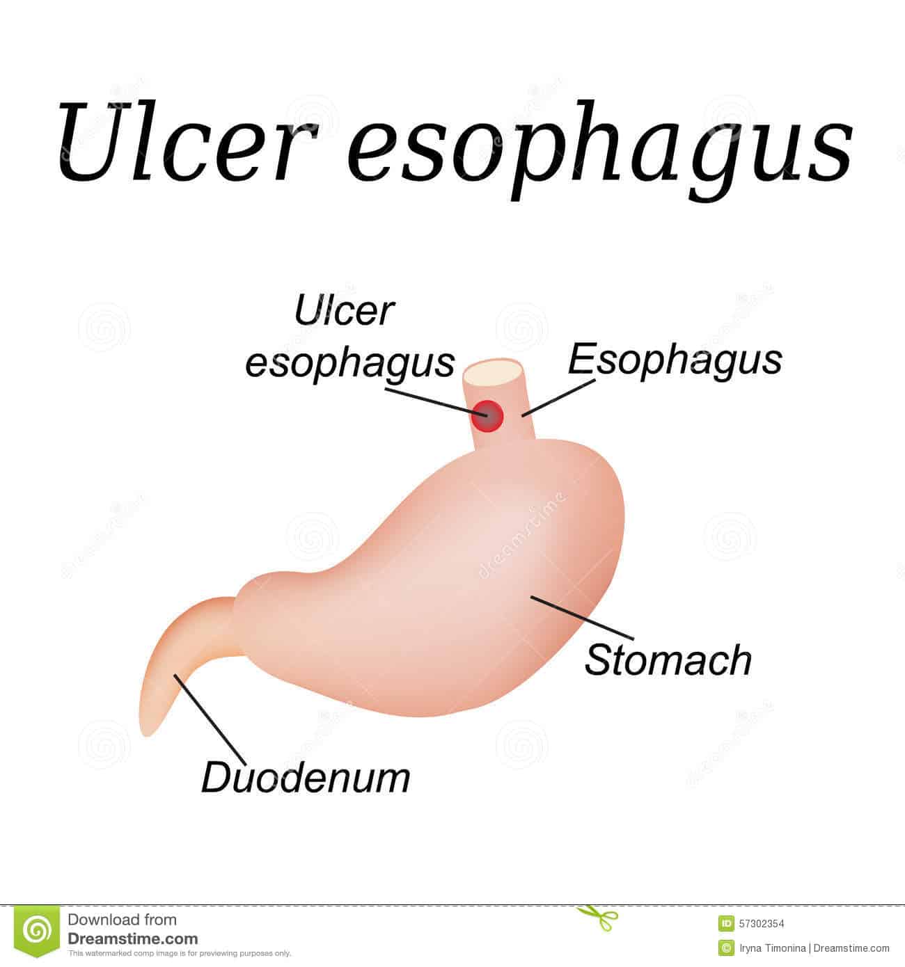 Esophagus Ulcer Affected. Ulcer Of Esophagus Stock Vector ...