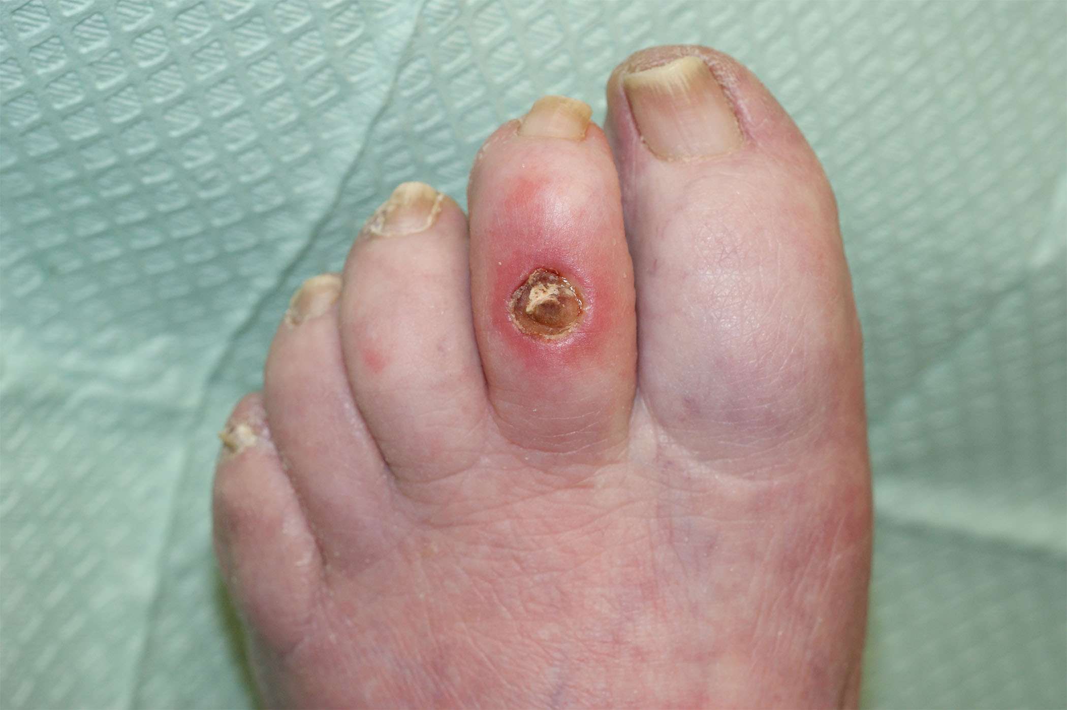 Evaluation of Peripheral Neuropathy in the Diabetic Foot