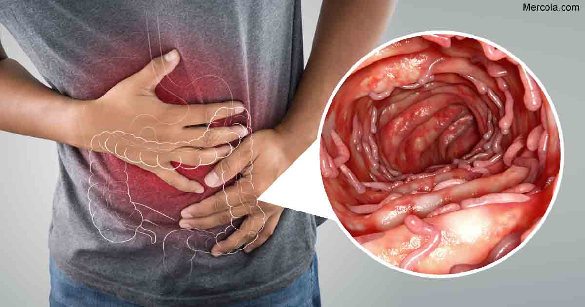 Everything You Need to Know About Ulcerative Colitis  SAM ...