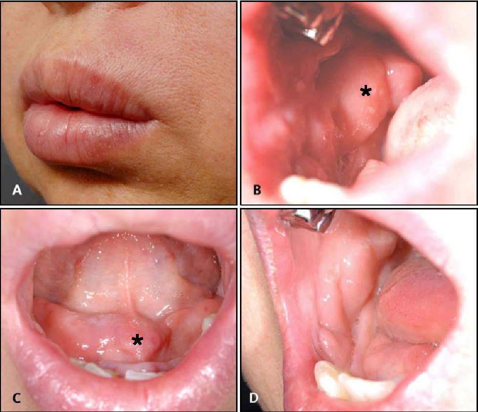 Figure 1 from Orofacial granulomatosis associated with ...