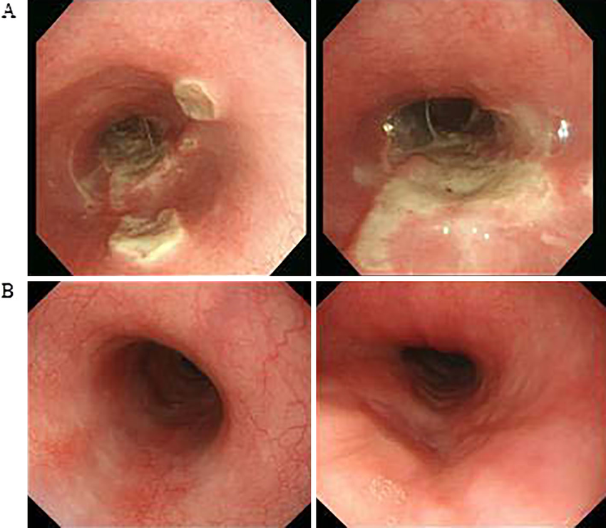 Figure1.The ulcer detected in the middle to lower intrathoracic ...