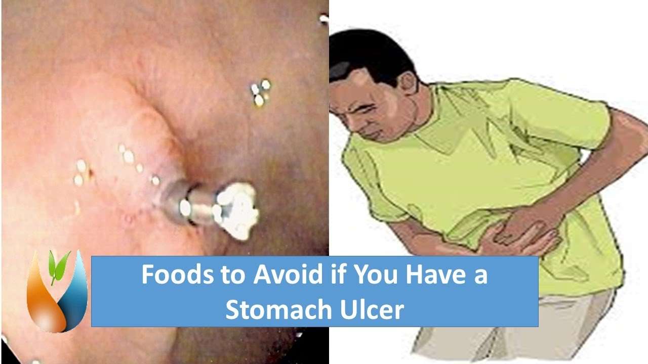 Foods to Avoid if You Have a Stomach Ulcer