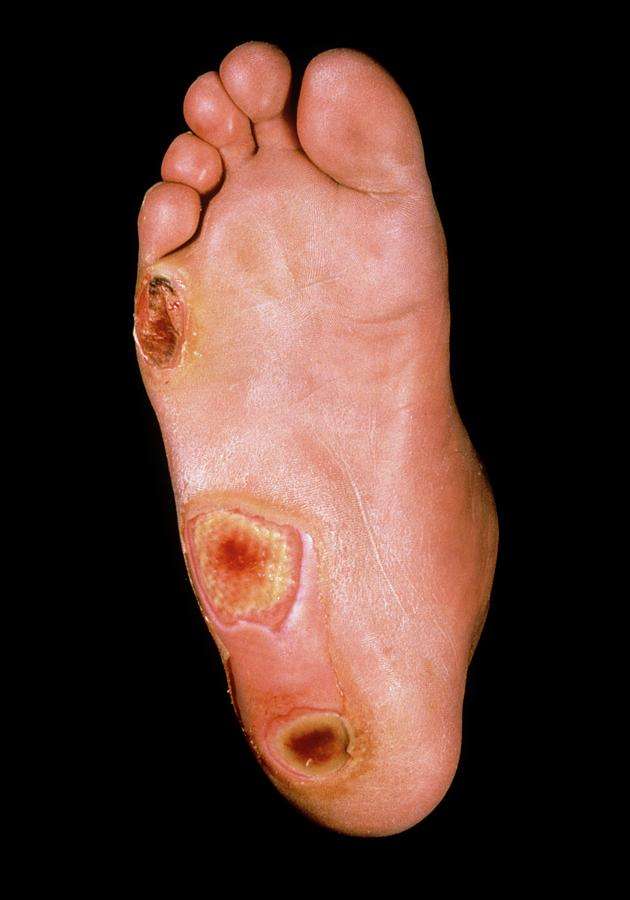 Foot Ulcers In Diabetes Photograph by St Bartholomew ...