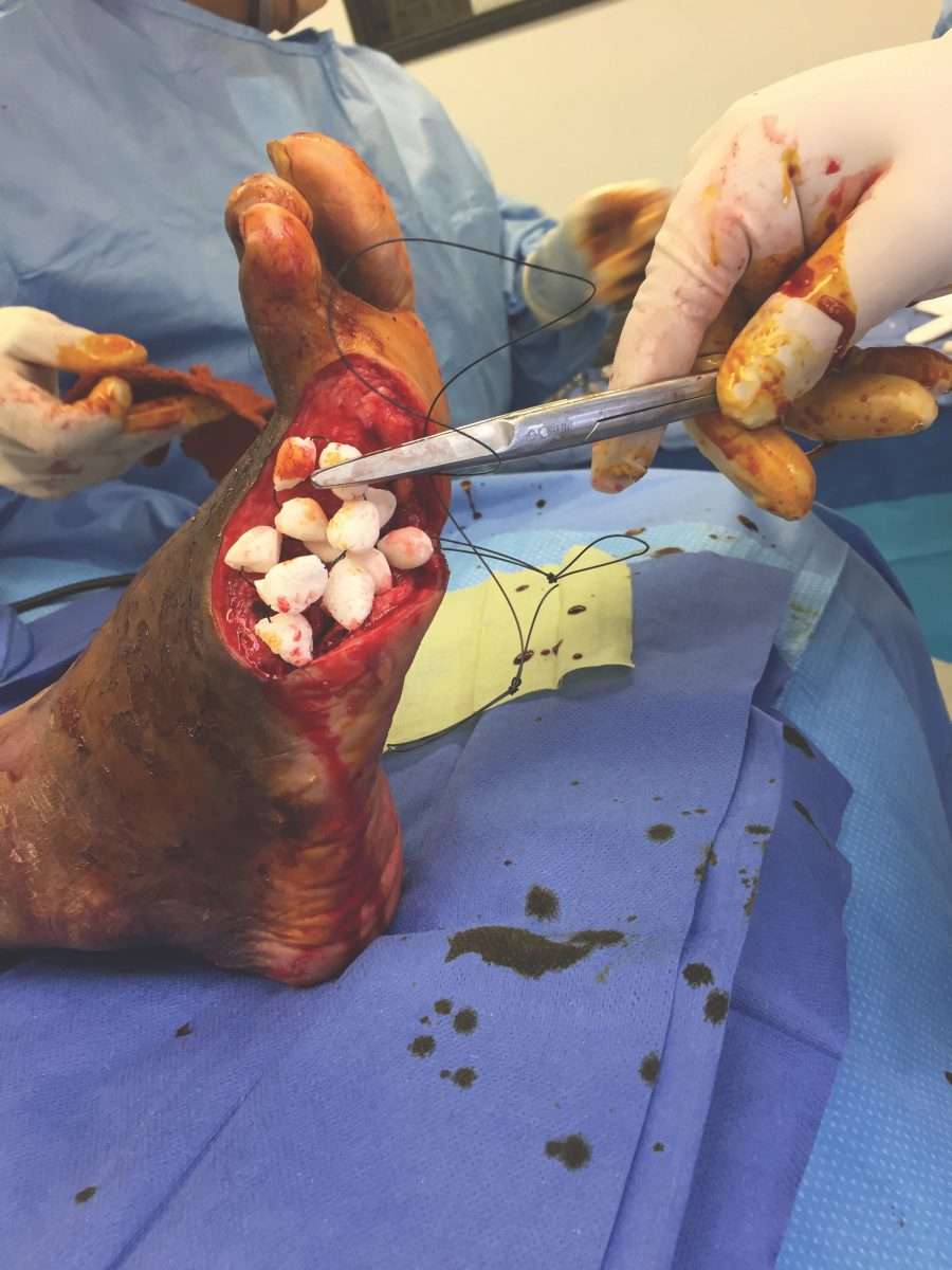 From Diabetic Foot Ulcers to Limb Salvage: A Surgical Perspective