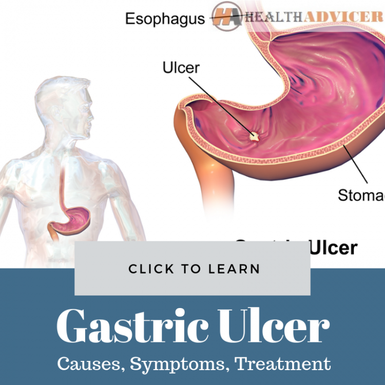 Gastric Ulcer: Causes, Picture, Symptoms and Treatment