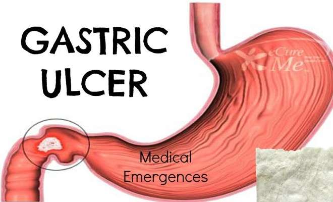 Gastric Ulcer: What You Need To Know