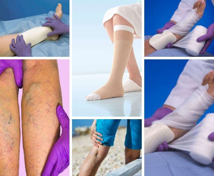Guide To Venous Leg Ulcers