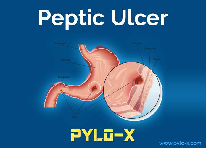 H. Pylori Treatment, Peptic Ulcer Disease