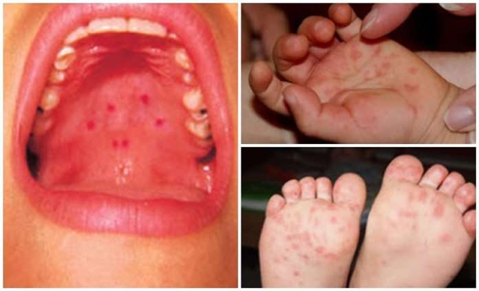 Hand, foot and mouth disease breaks out in the South ...