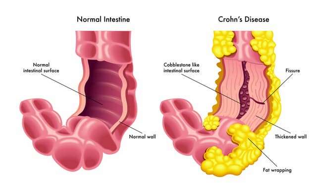 Here are the 5 best Homeopathic medicines for Crohn