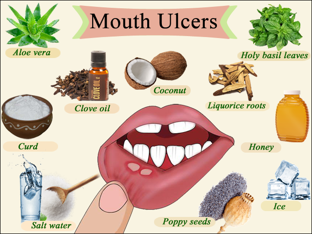 Home Remedies for mouth ulcers
