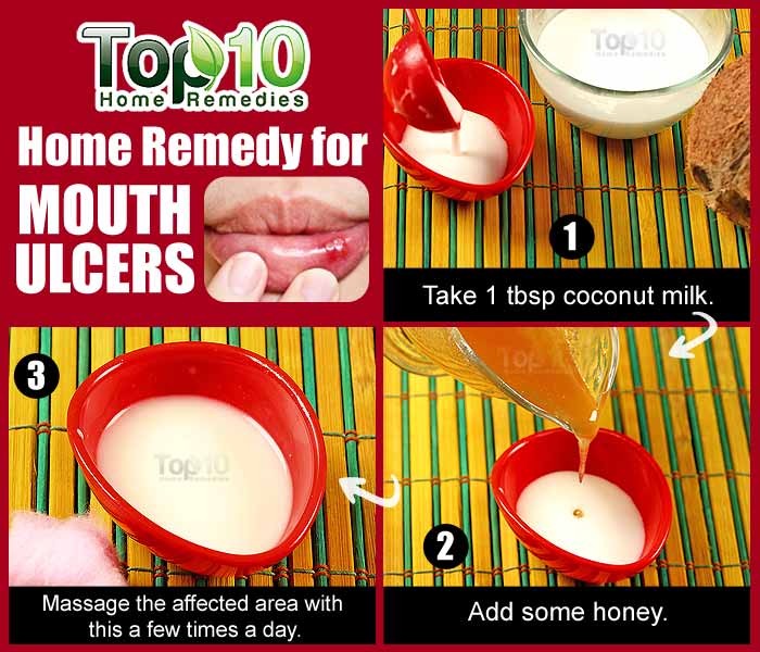 Home Remedies for Mouth Ulcers