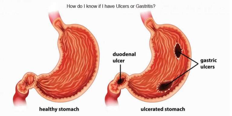 How do I know if I have Ulcers or Gastritis?