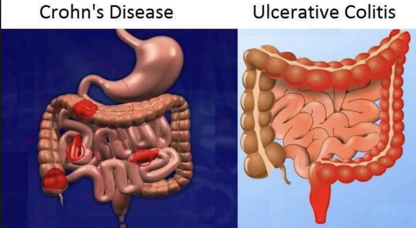 How is IBD Diagnosed?