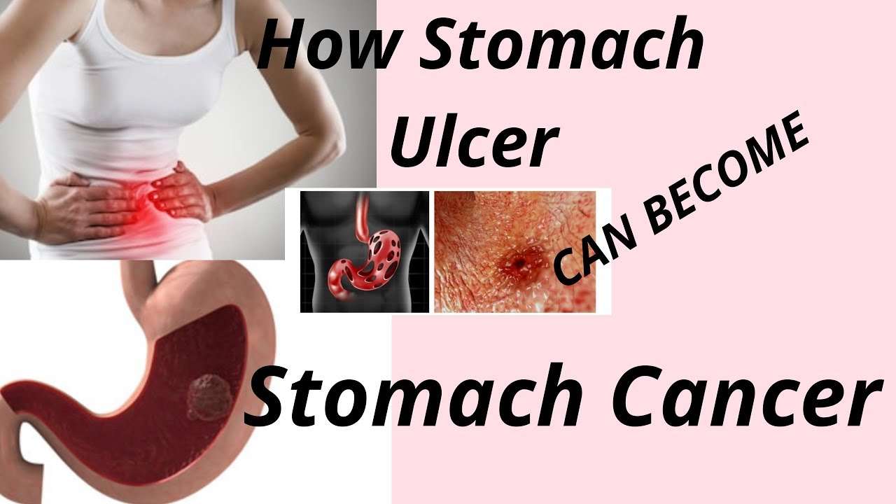 HOW STOMACH ULCER CAN TURN TO STOMACH CANCER