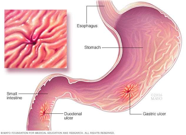 How to check for stomach ulcer