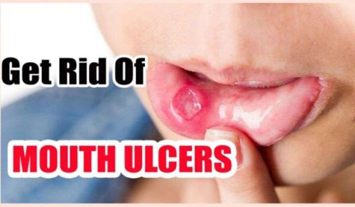 How to Cure Mouth Ulcers Fast with 10 Home Remedies ...