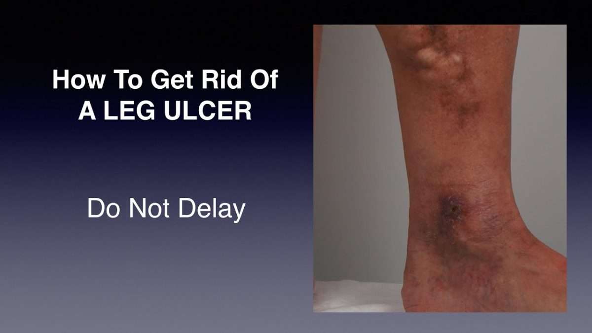 How To Get Rid of A Leg Ulcer
