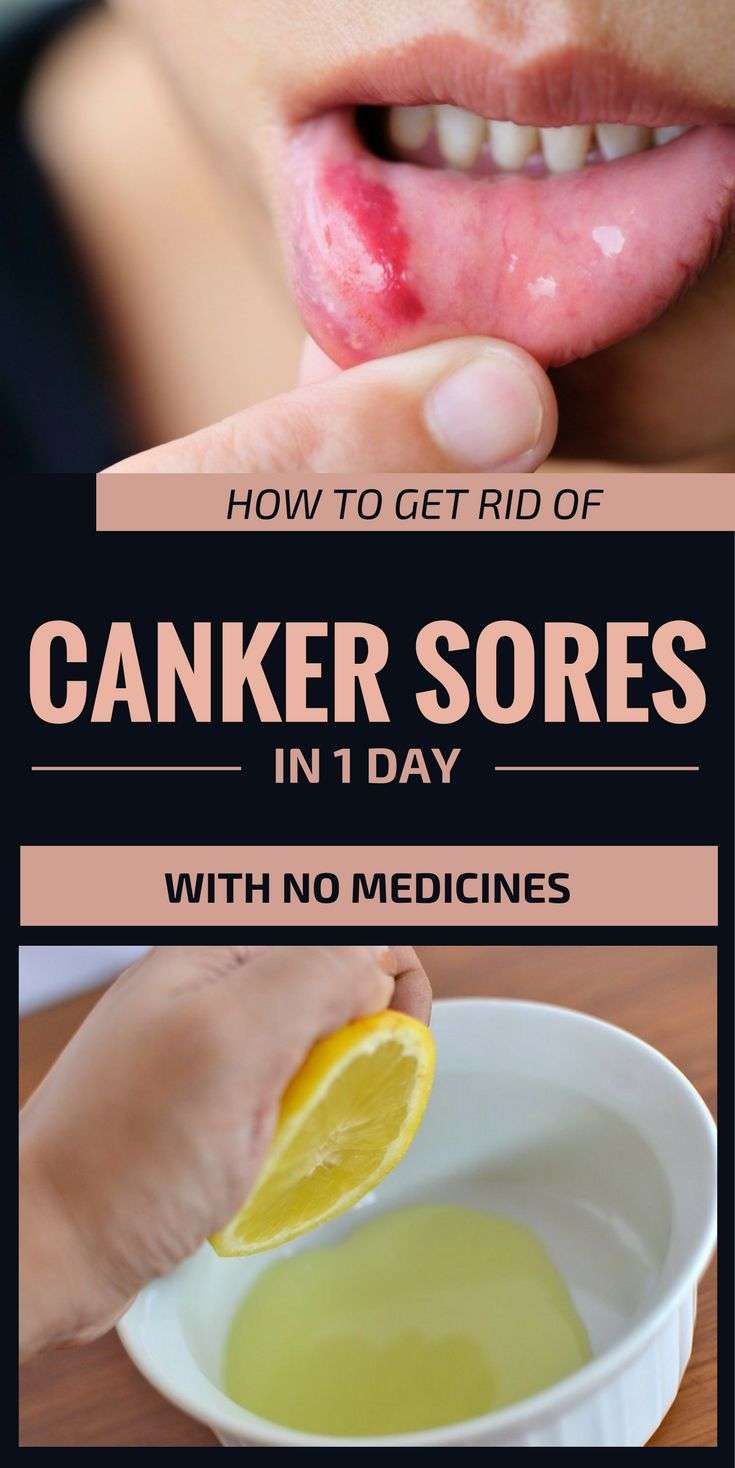 How To Get Rid Of Canker Sores In 1 Day With No Medicines ...