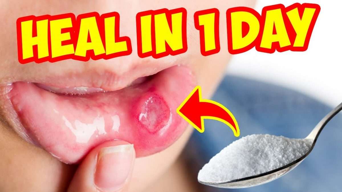 How To Get Rid Of Canker Sores On Mouth