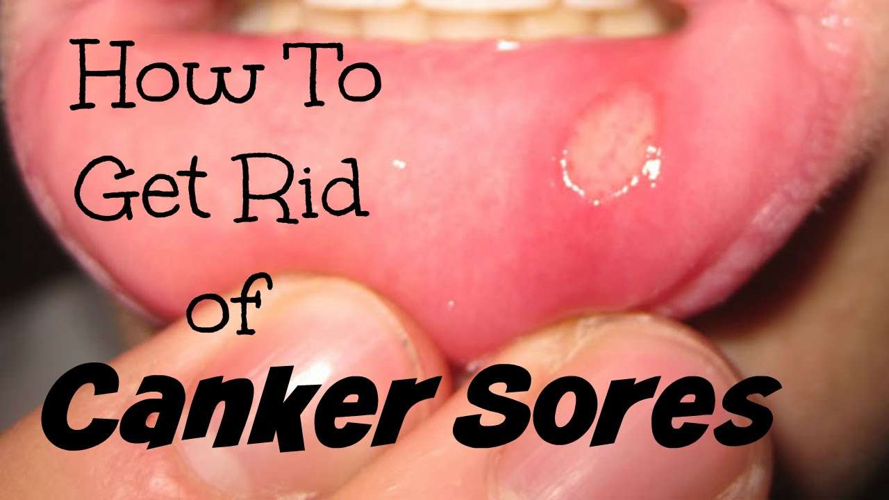How To Get Rid of Canker Sores
