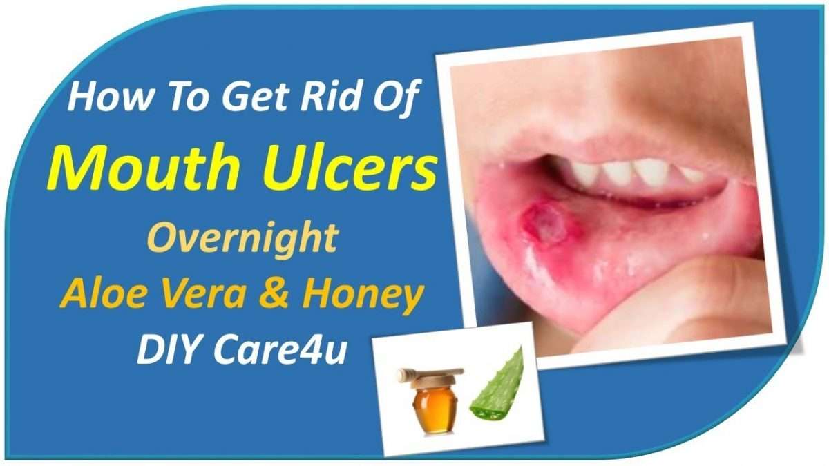How To Get Rid Of Mouth Ulcers Overnight