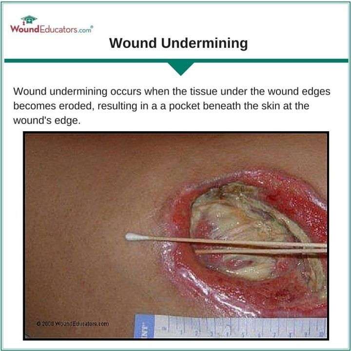 How to Measure Wound Undermining