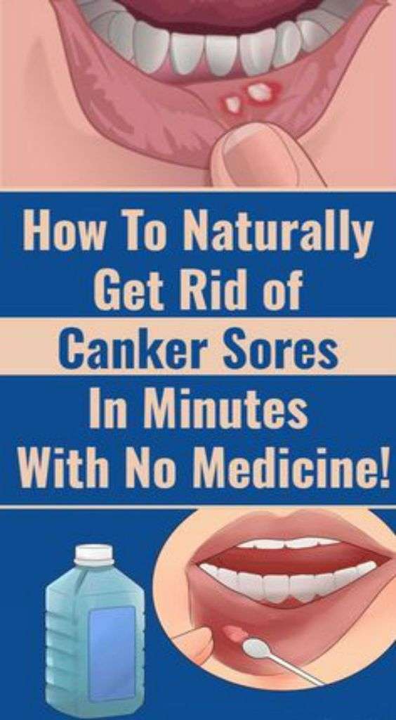 How to naturally get rid of #Canker #sores or #Mouth # ...