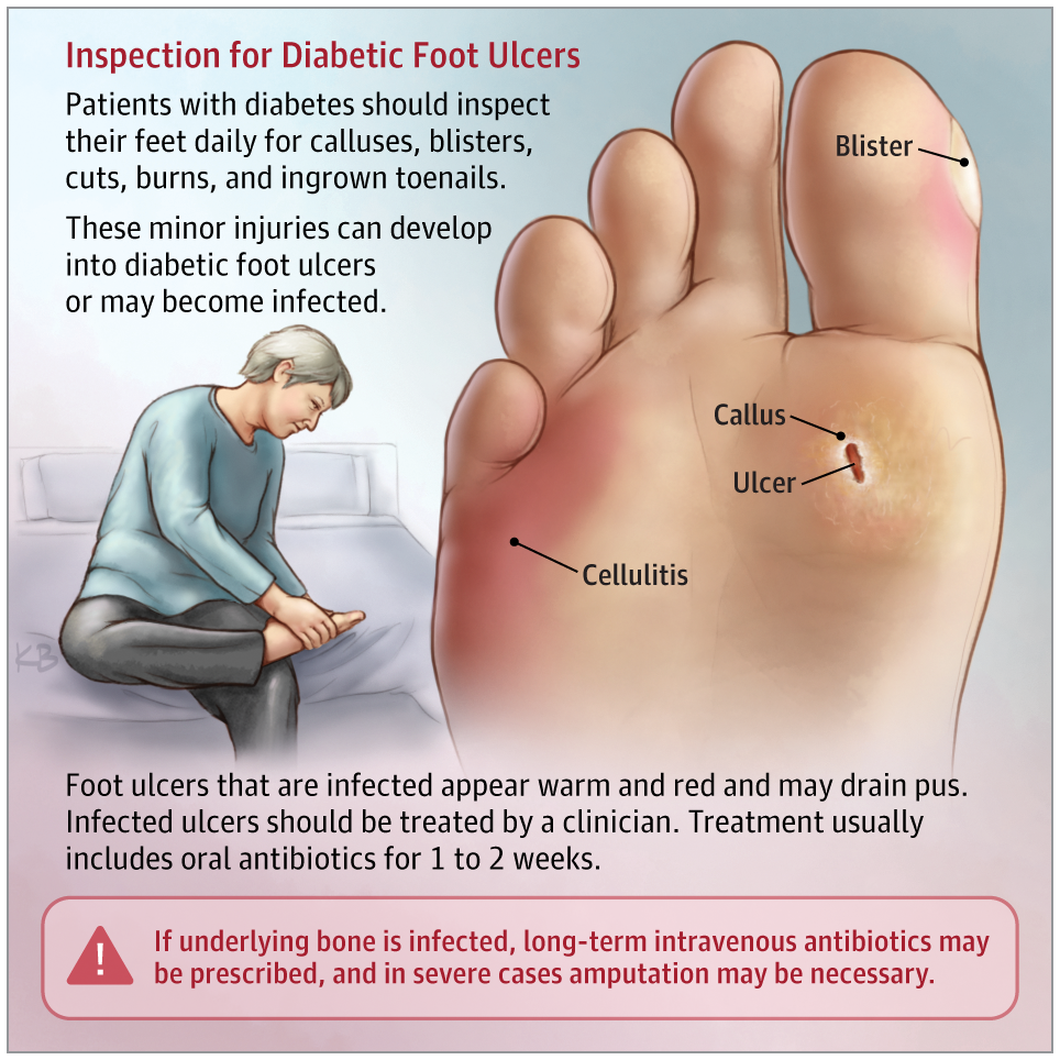 how to treat a diabetic foot infection in 2020