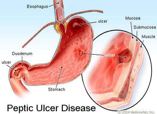 How to treat a peptic ulcer