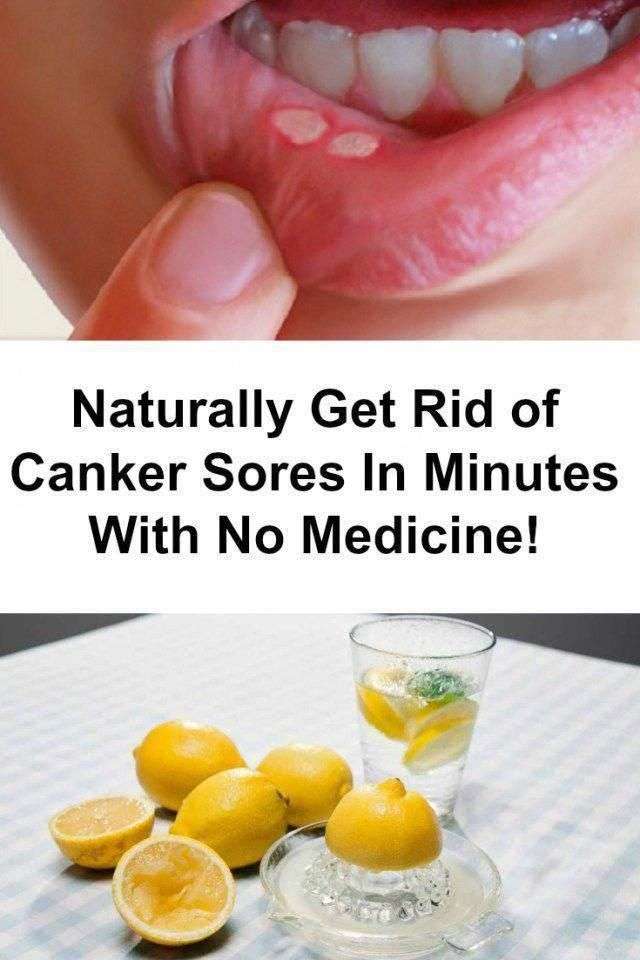 How to treat mouth ulcers &  canker sores naturally...#health # ...