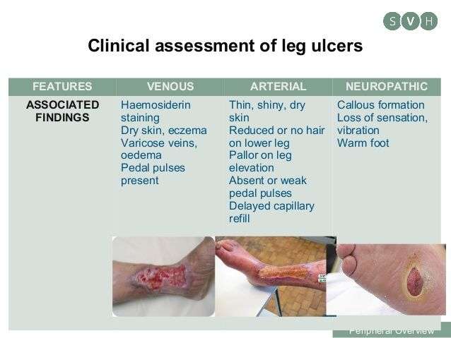 Image result for venous and arterial ulcers