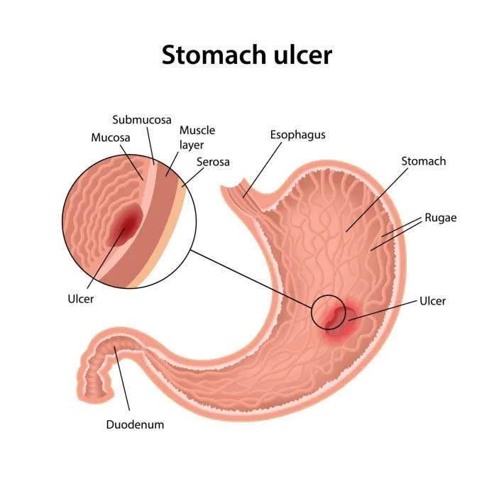 Is Stomach Ulcer Pain Worse At Night