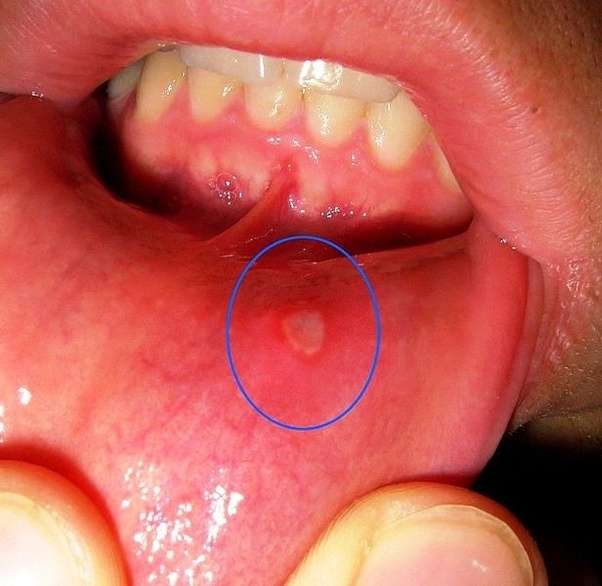 Is there any remedy for a canker sore?