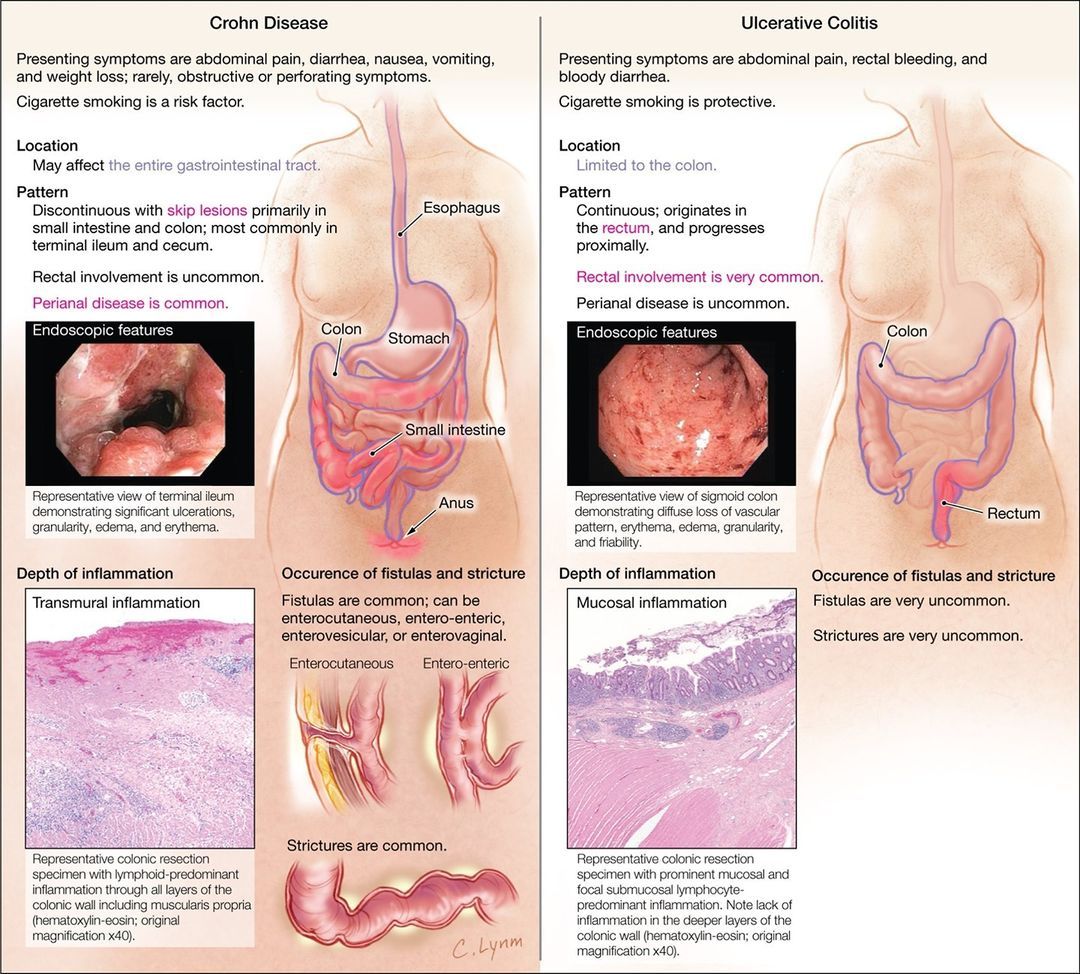 JAMA Network on Instagram: Crohn Disease vs Ulcerative Colitis ...