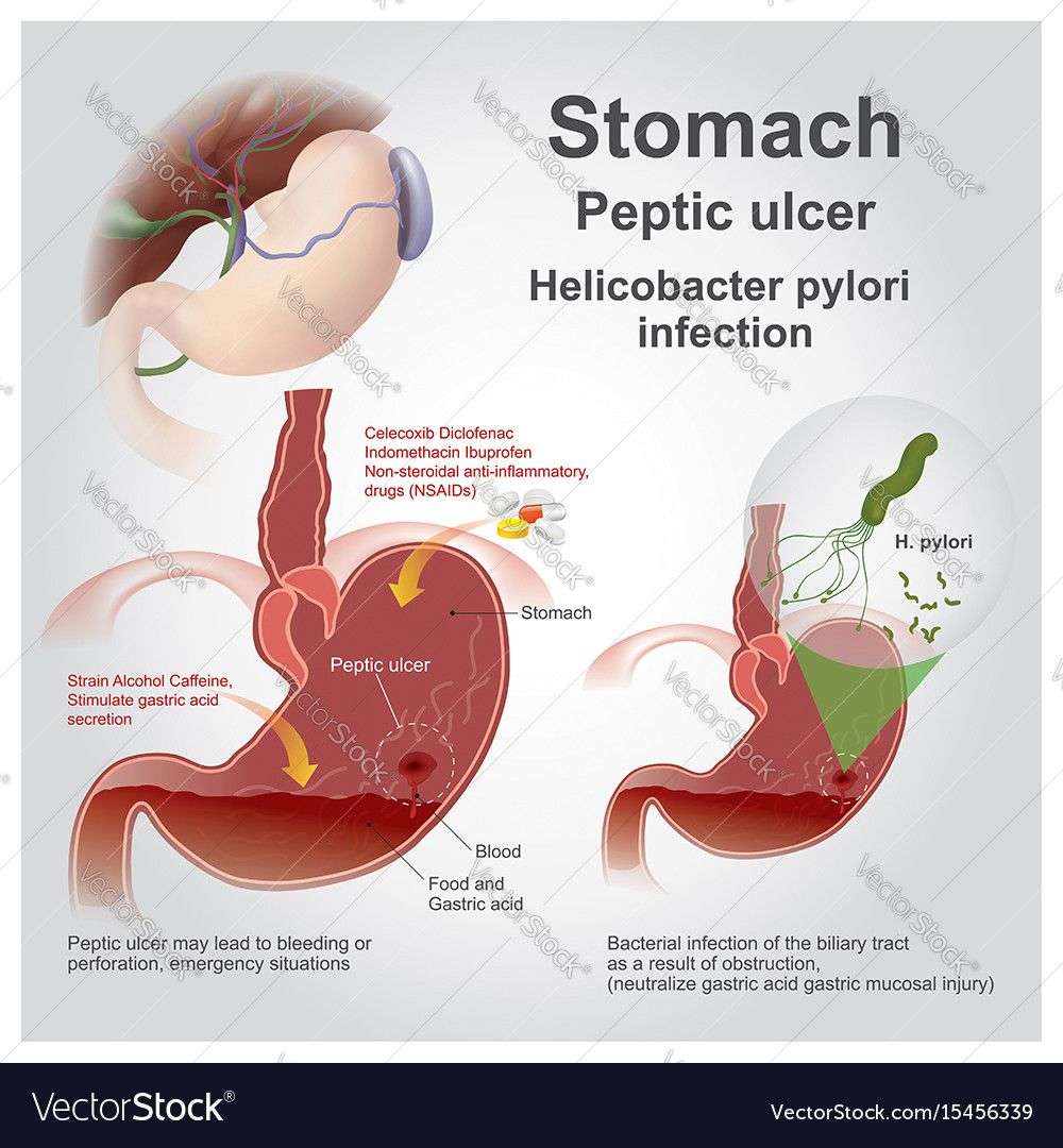 Lab Results For Peptic Ulcer Disease