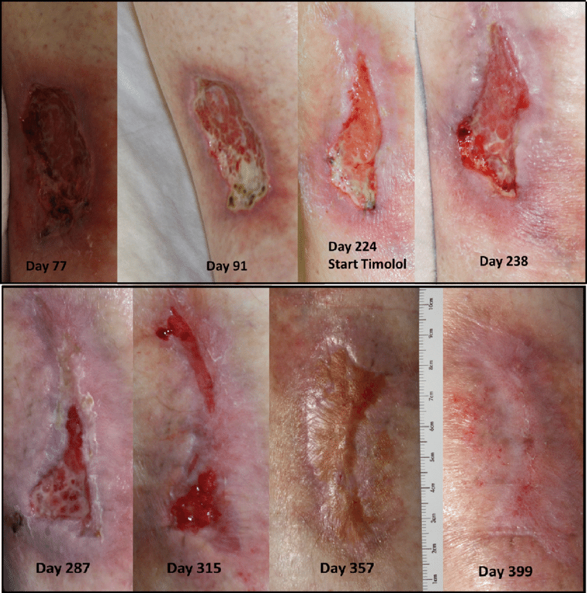 Leg ulcer. Qualitative depiction of wound healing over time.