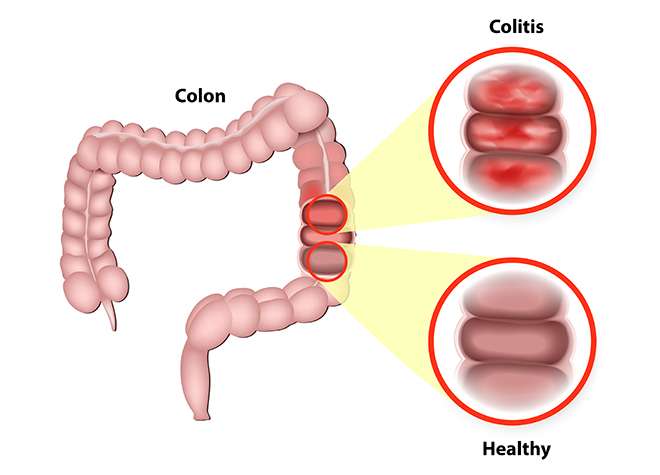 Living With Ulcerative Colitis
