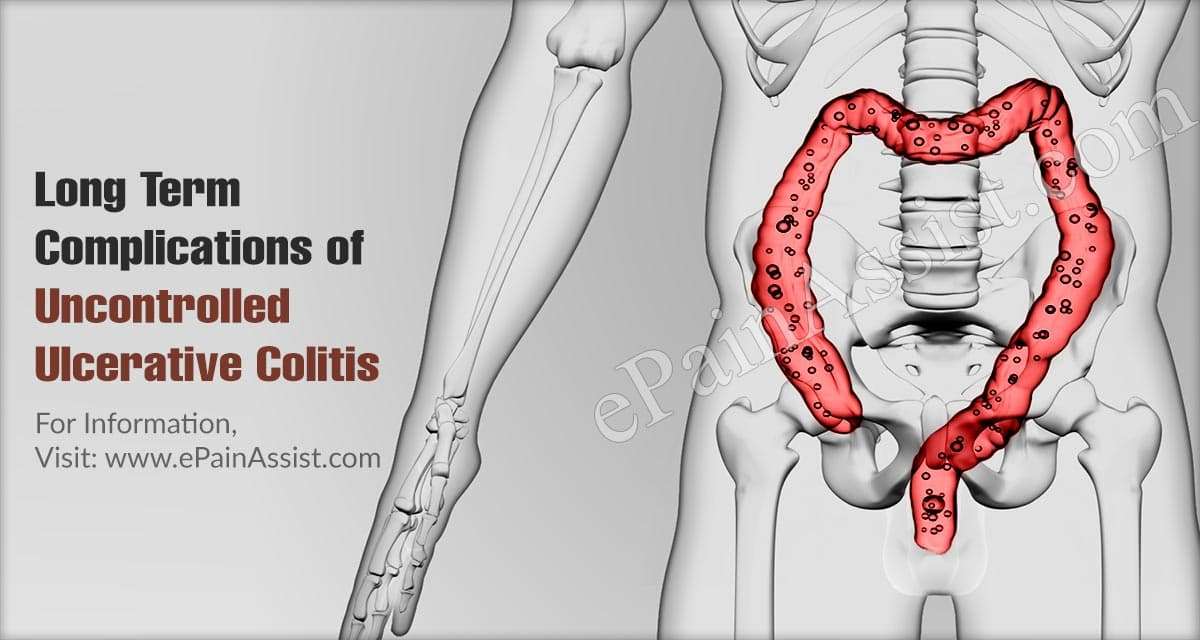Long Term Complications of Uncontrolled Ulcerative Colitis