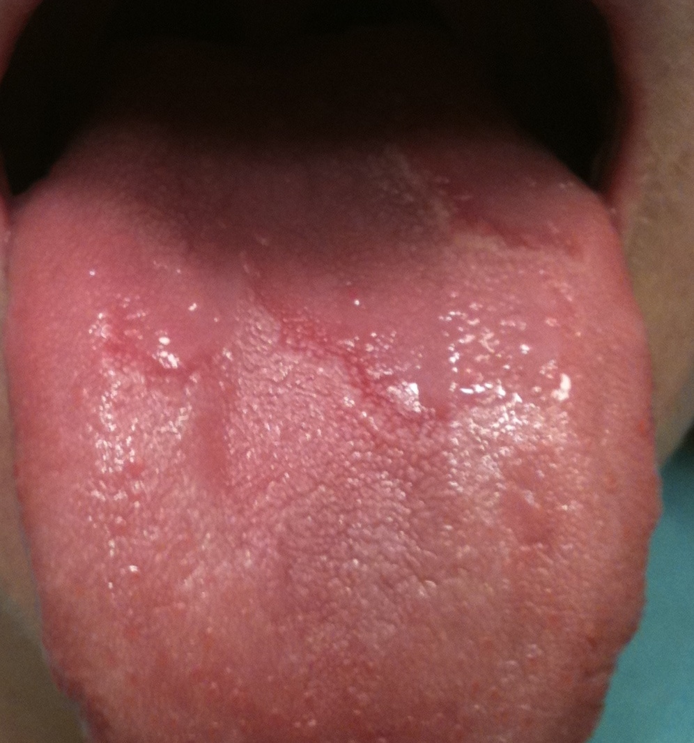 Lupus Tongue Sores
