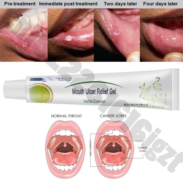 Mouth Ulcer Relief Gel Natural Herbal Oral Antibacterial Cream Fast ...
