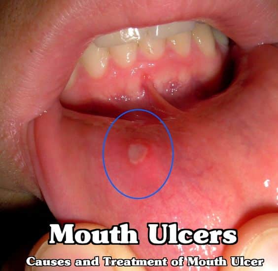 Mouth Ulcers â Causes and Treatment of Mouth Ulcer
