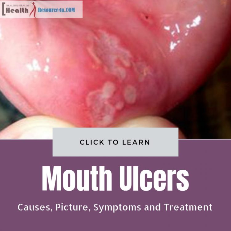 Mouth Ulcers : Causes, Picture, Symptoms and Treatment