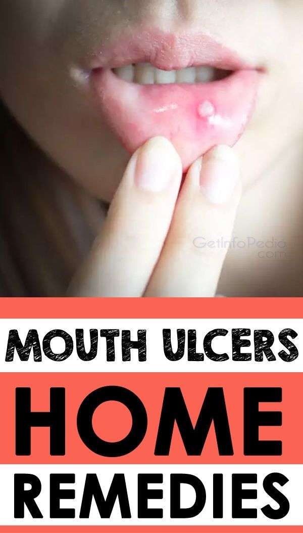 Mouth Ulcers Home Remedies