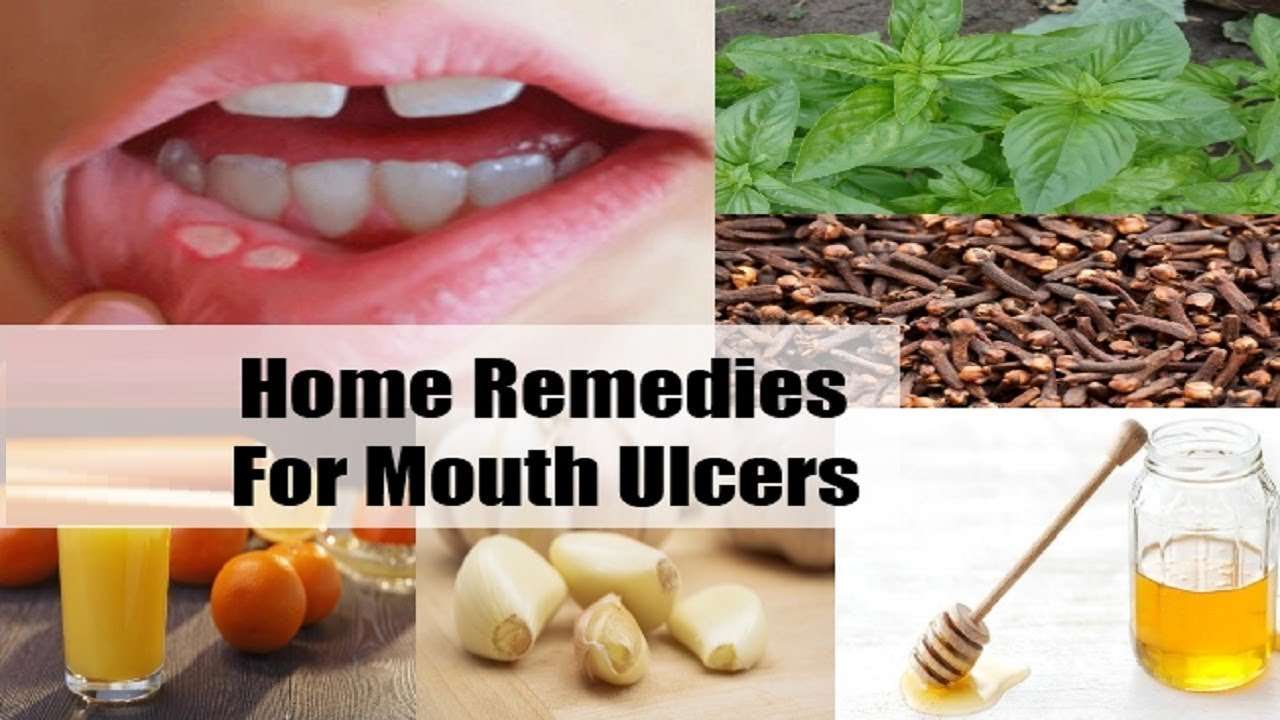 Mouth Ulcers: Natural Home Remedies To Get Rid of.