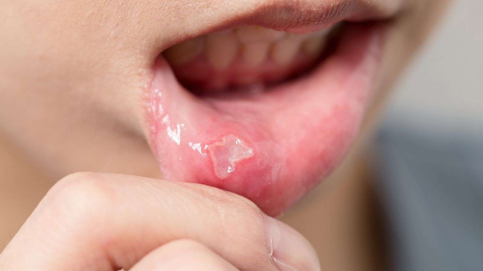 Oral Lesions, Ulcers, and Sores and How to Treat Them