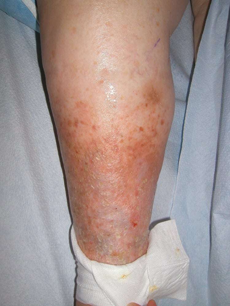 Patient 2: Elderly woman before treatment. She has severe leg swelling ...