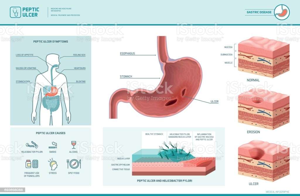 Peptic Ulcer And Helicobacter Pylori Infographic Stock ...