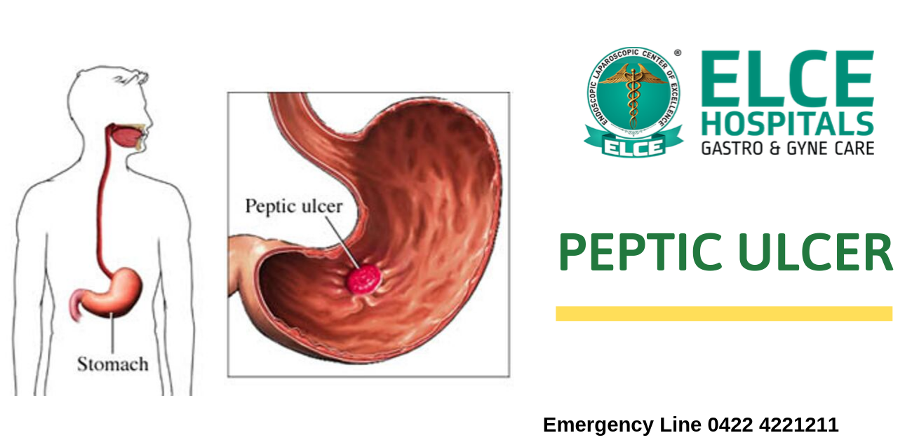 Peptic Ulcer, Peptic Ulcer Disease